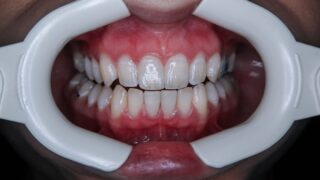 ホワイトニングは効果ある?費用・痛み・持続期間の目安と男の確認手順